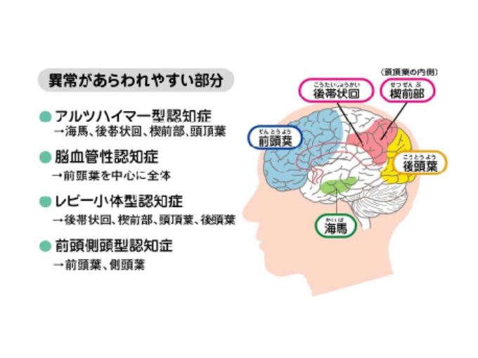 認知症異常部分