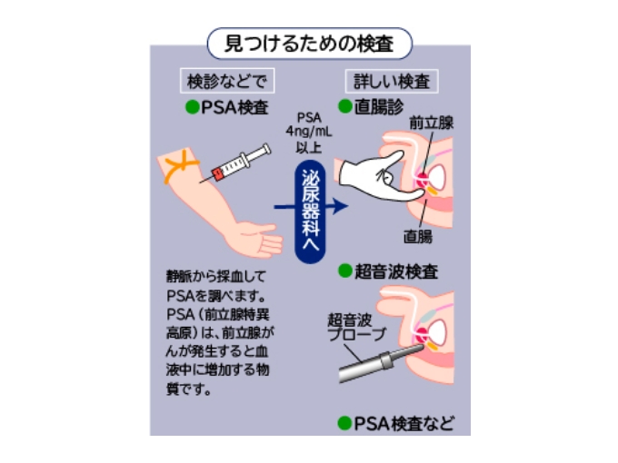 前立腺がんの検査