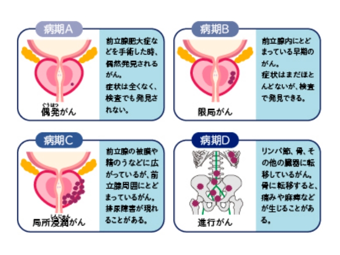 前立腺がんの病期_ABCD分類