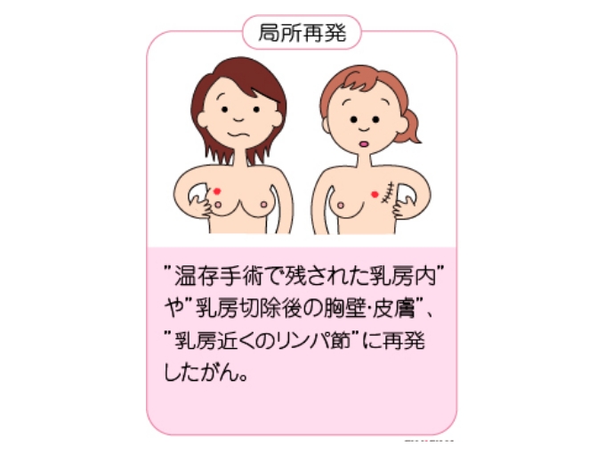 乳がんの局所再発