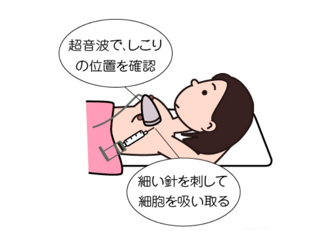 乳がん細胞診